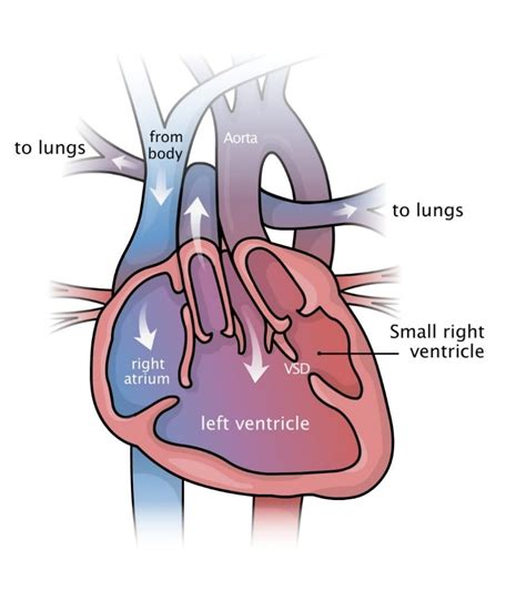 double inlet lv|double inlet left ventricle symptoms.